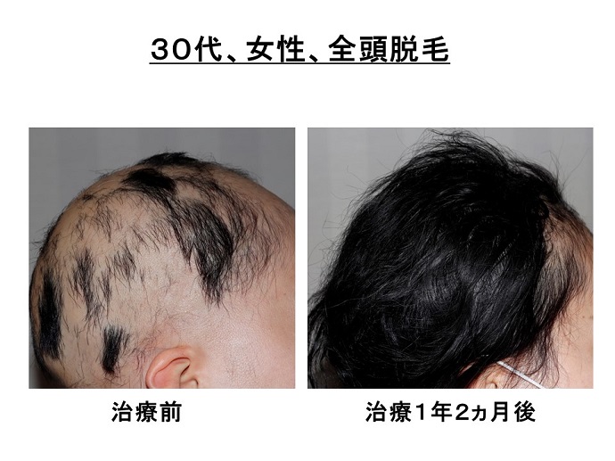 汎発性脱毛　病院